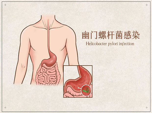幽门螺杆菌是什么